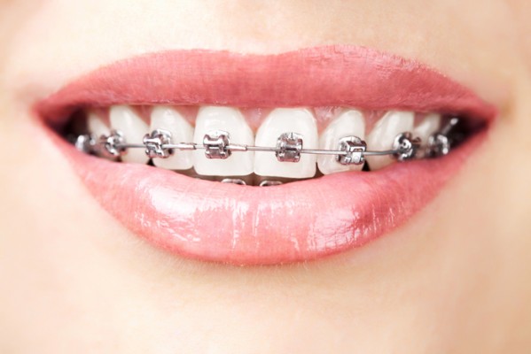 brackets-metalicos